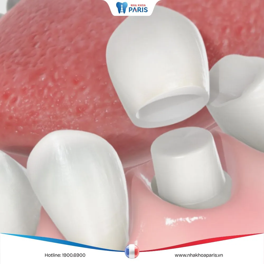 Những trường hợp không nên bọc răng sứ – Bác sĩ nha khoa giải đáp