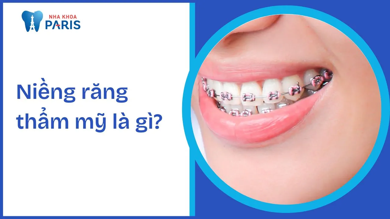 Niềng răng thẩm mỹ là gì? 4 phương pháp niềng phổ biến