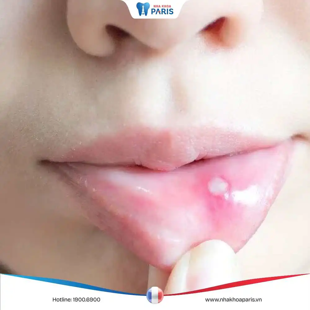 Mụn nước trong khoang miệng: Loại bỏ nhanh chóng, hiệu quả
