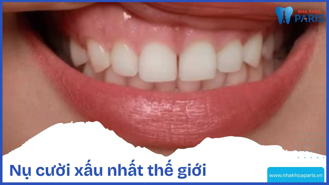 Nụ cười xấu nhất thế giới và cách cải thiện nụ cười