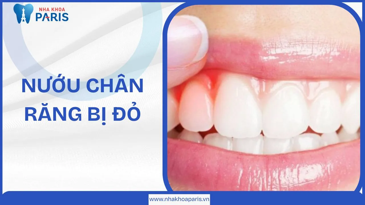 Nướu chân răng bị đỏ là dấu hiệu của bệnh lý gì? Biện pháp điều trị