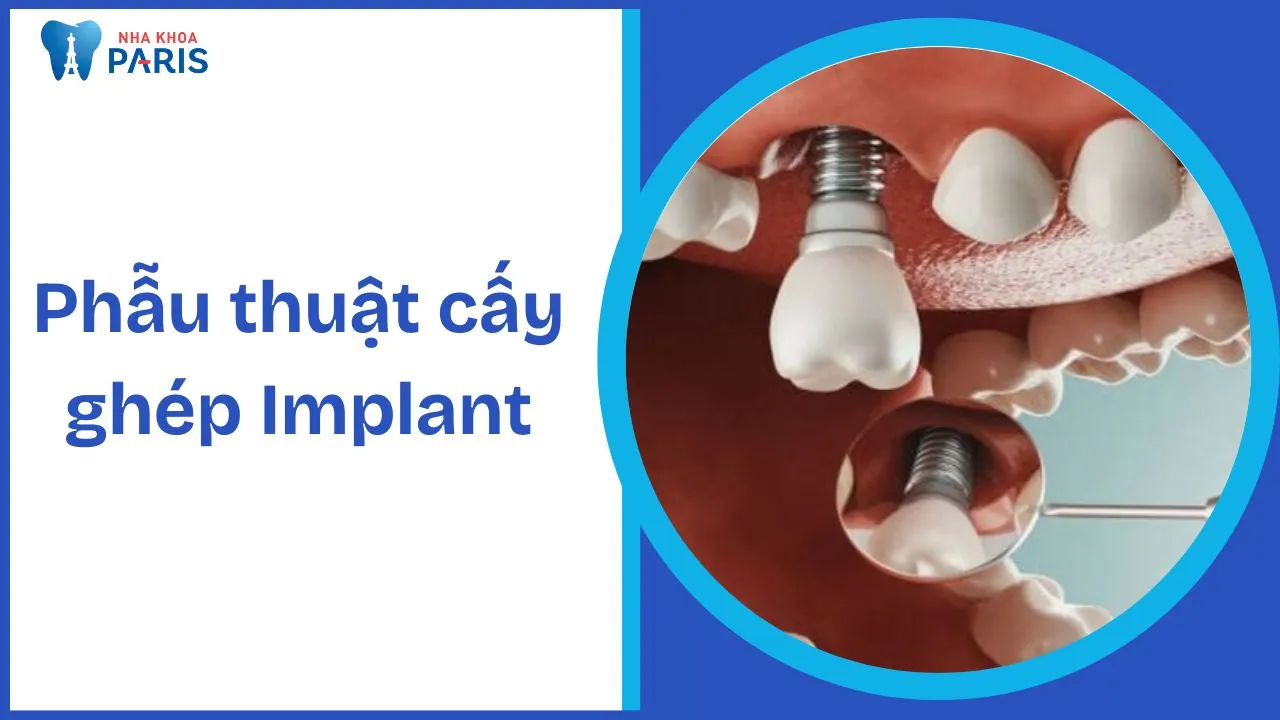 Phẫu thuật cấy ghép Implant –  Giải pháp tối ưu cho người mất răng