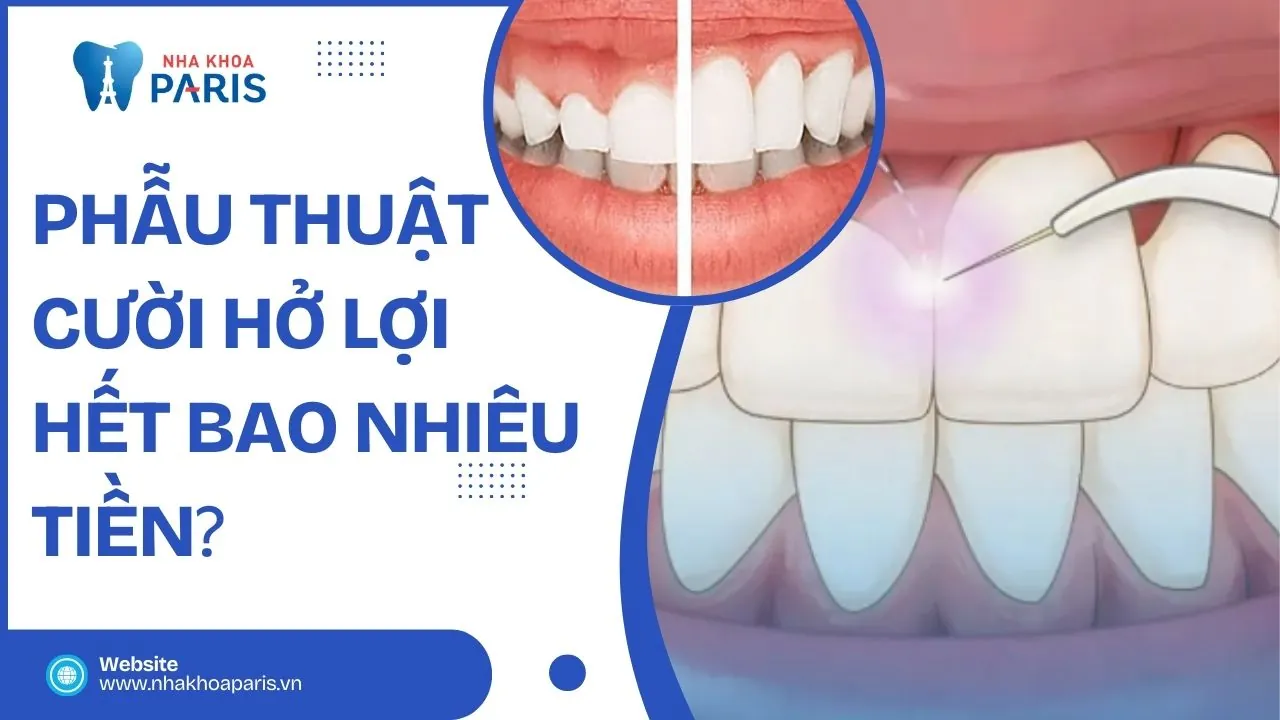 Phẫu thuật cười hở lợi hết bao nhiêu tiền? Báo giá mới nhất 2025