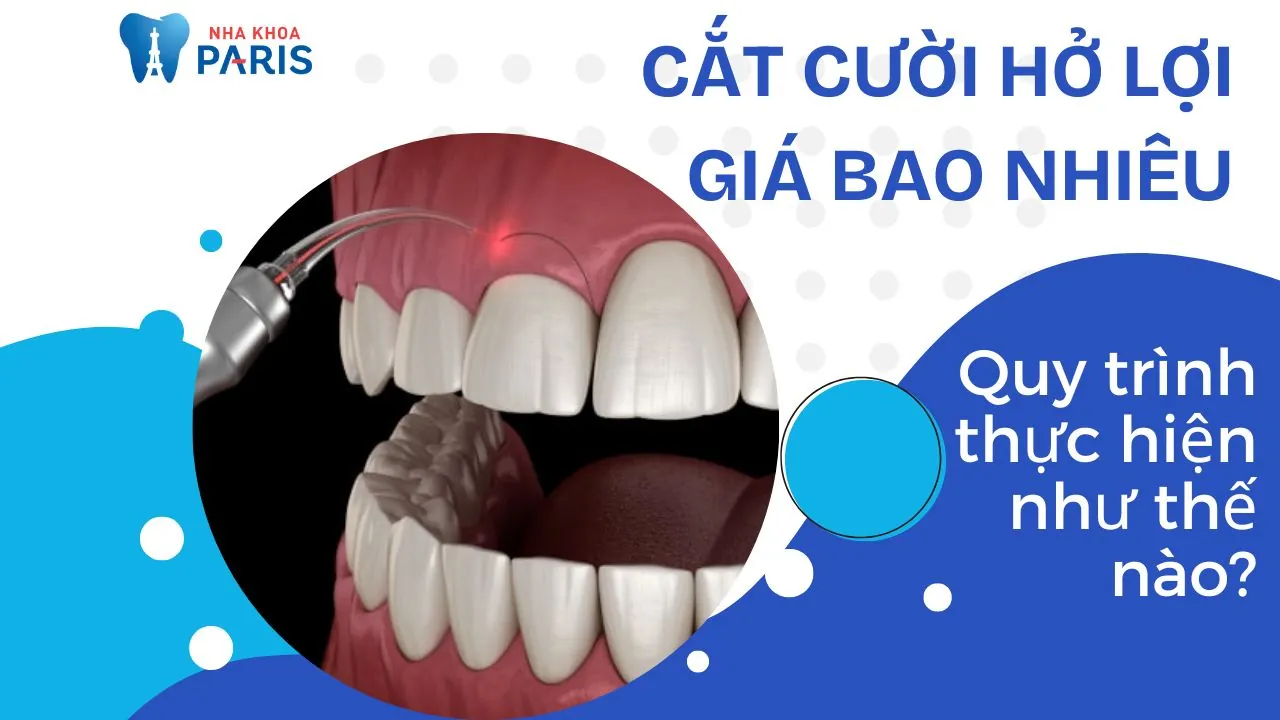 Cắt cười hở lợi giá bao nhiêu? Quy trình thực hiện như thế nào?