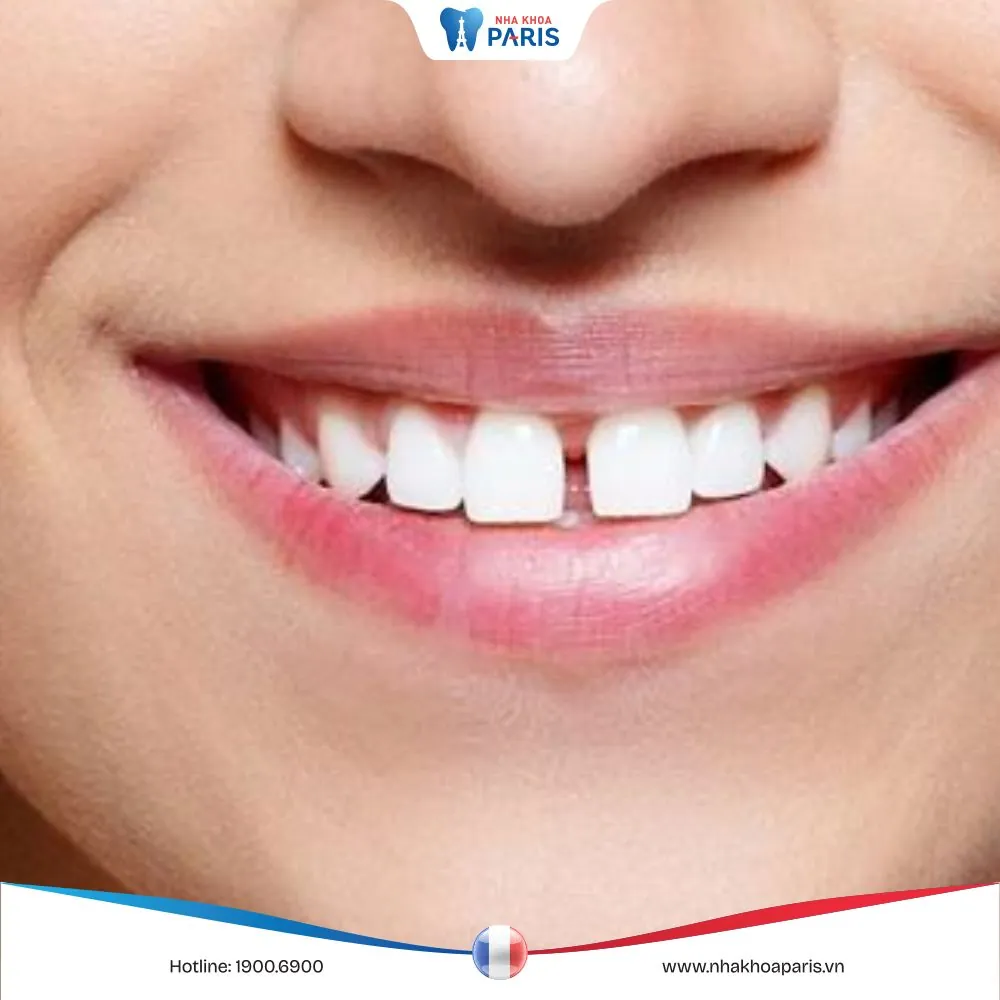 Răng cửa thưa do đâu? Tướng số của người có răng cửa thưa
