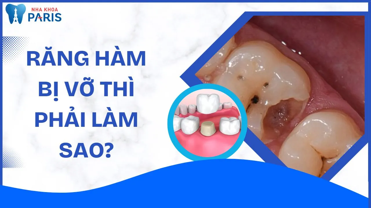 Răng Hàm Bị Vỡ Thì Phải Làm Sao? Hướng Dẫn Toàn Diện Từ Nguyên Nhân Đến Phục Hồi
