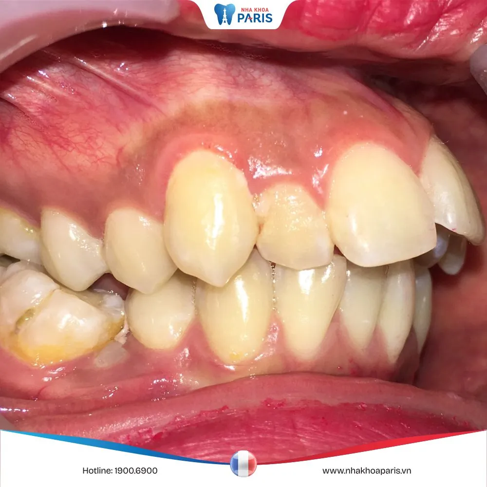 Răng hô là gì – 3 phương pháp khắc phục hiệu quả
