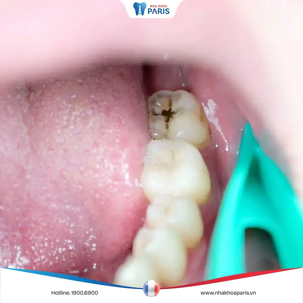 Răng khôn bị sâu nên làm gì? Phương pháp điều trị hiệu quả