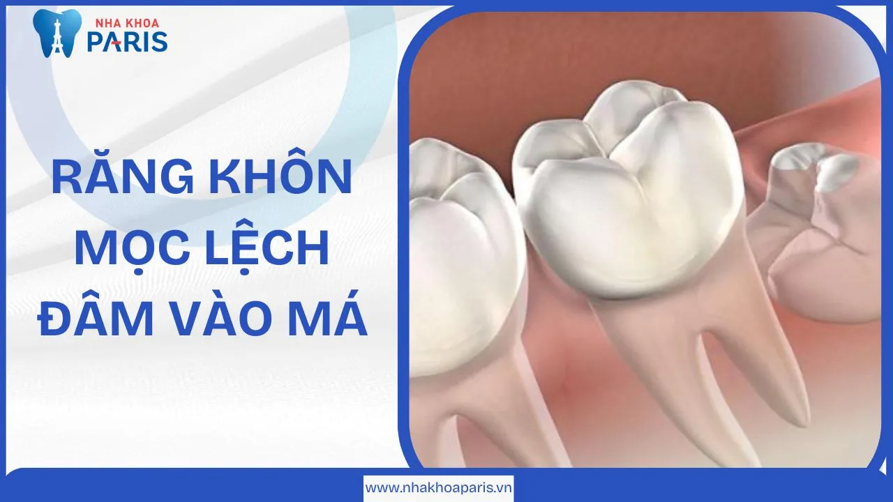 Nguy hiểm và biến chứng khi răng khôn mọc lệch đâm vào má