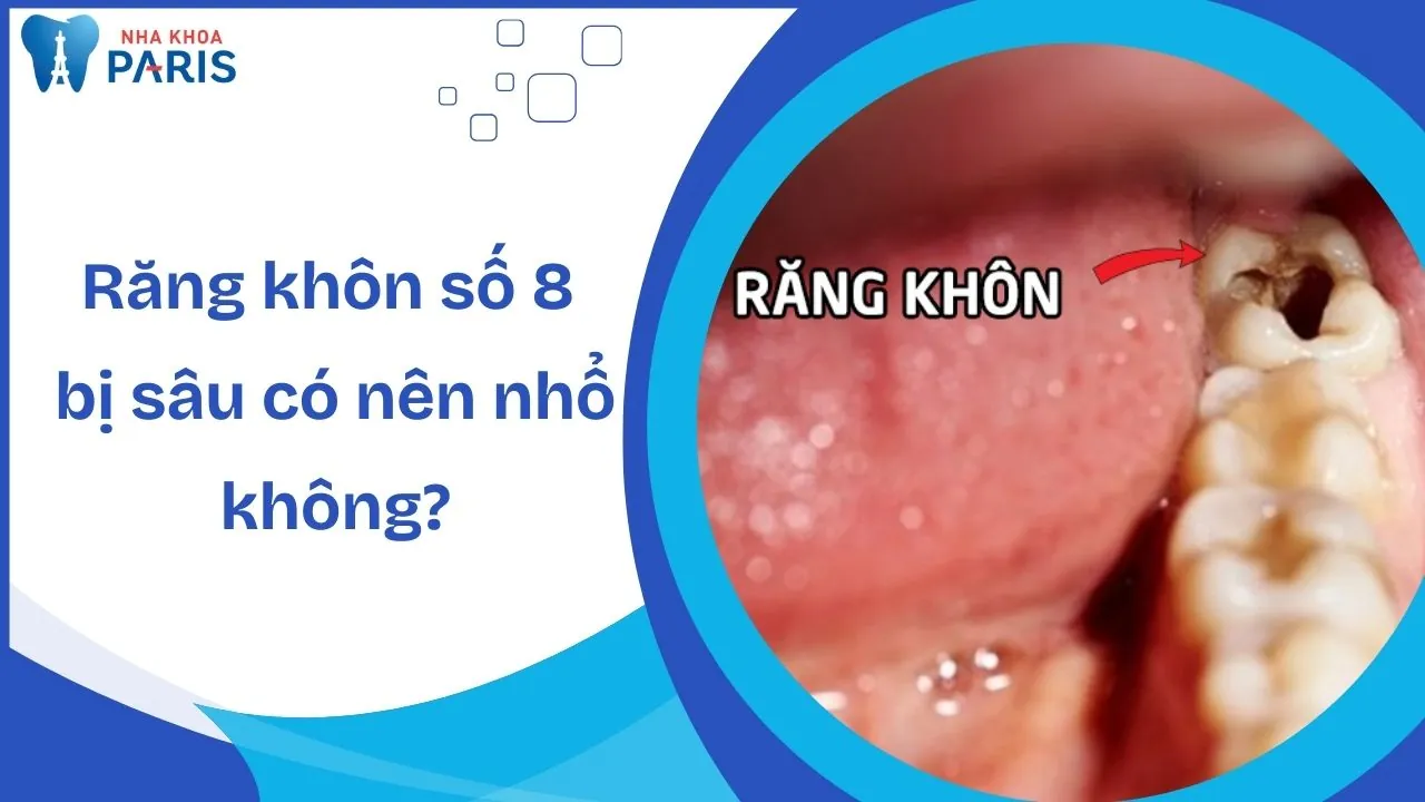 Răng khôn số 8 bị sâu có nên nhổ không? Cách xử lý triệt để nhất