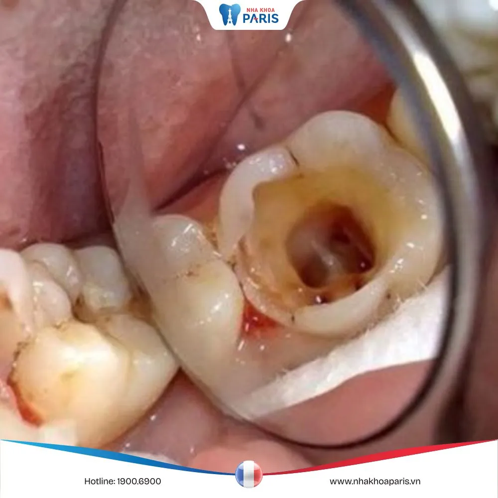 Răng sâu bị vỡ lớn: Nguy cơ và cách khắc phục tốt nhất