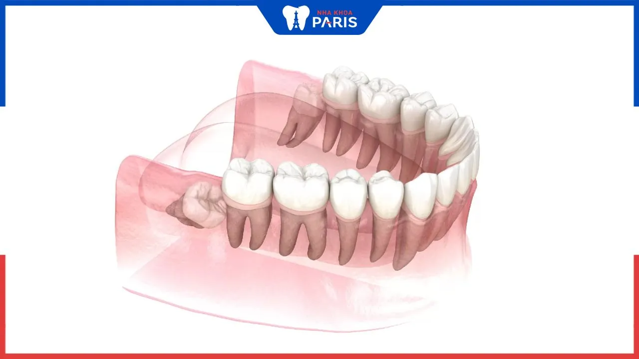 Răng trong cùng mọc khi nào? Tác hại của răng mọc lệch, mọc ngầm