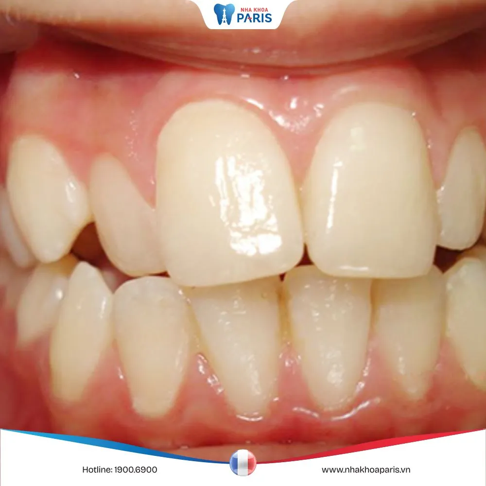 Răng vẩu: Nguyên nhân hình thành, triệu chứng và điều trị