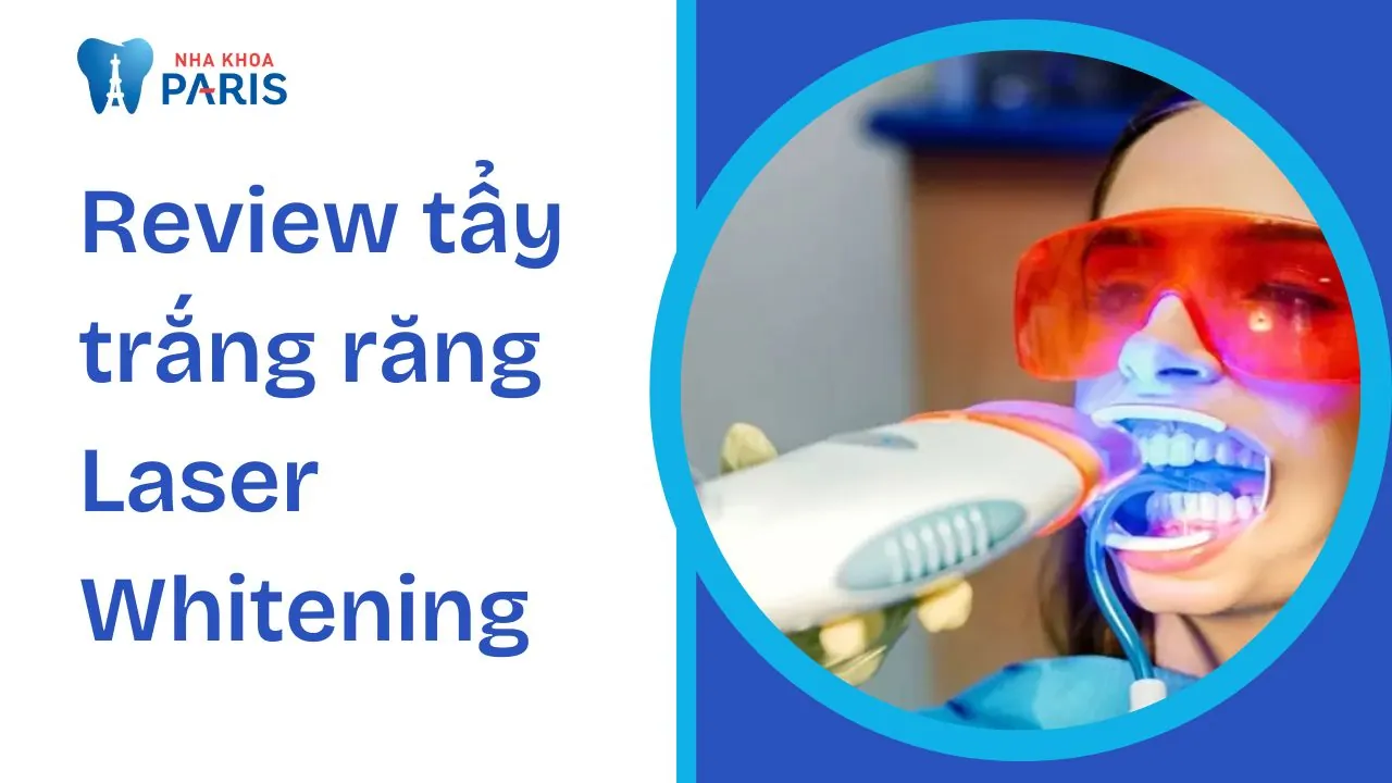 Tẩy trắng răng Laser Whitening: Ưu điểm, quy trình và chi phí