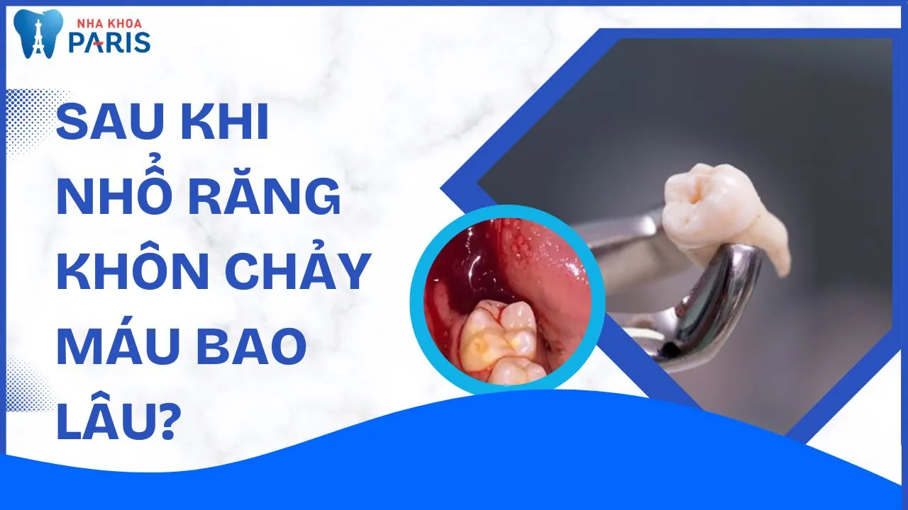 Sau khi nhổ răng khôn chảy máu bao lâu: Thời gian và nguy hiểm tiềm ẩn