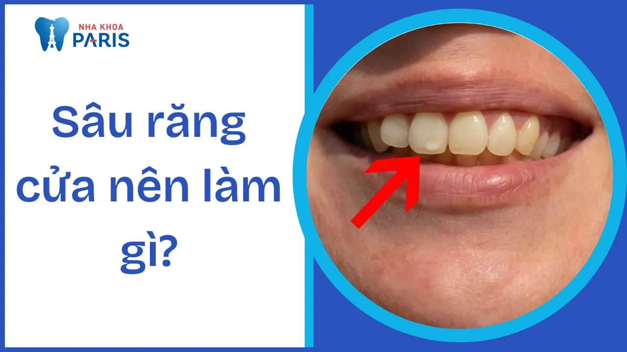Sâu răng cửa nên làm gì? Hướng dẫn chi tiết cho từng giai đoạn