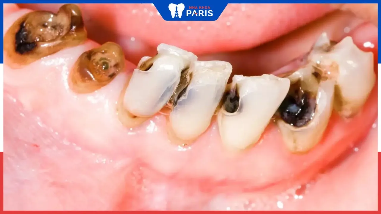 Sự thật về vi khuẩn sâu răng dưới kính hiển vi có thể bạn chưa biết