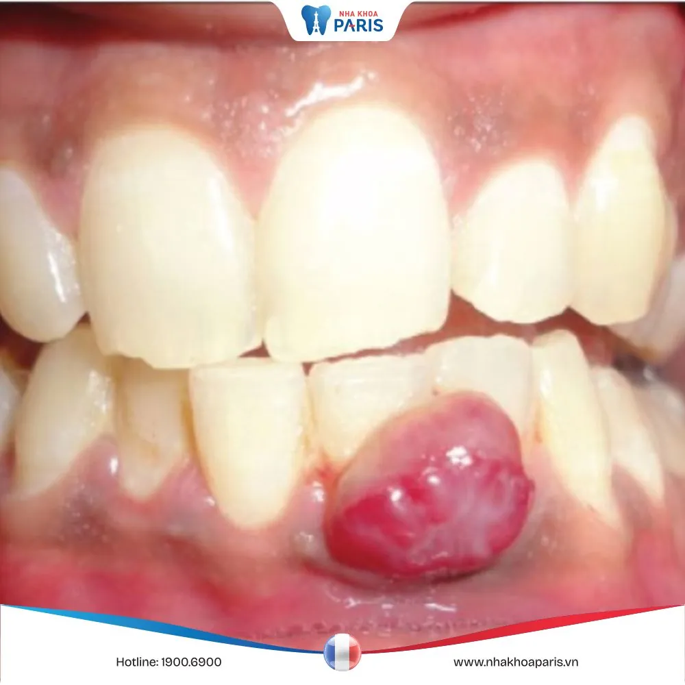 Sưng lợi: Nguyên nhân và cách chữa trị dứt điểm