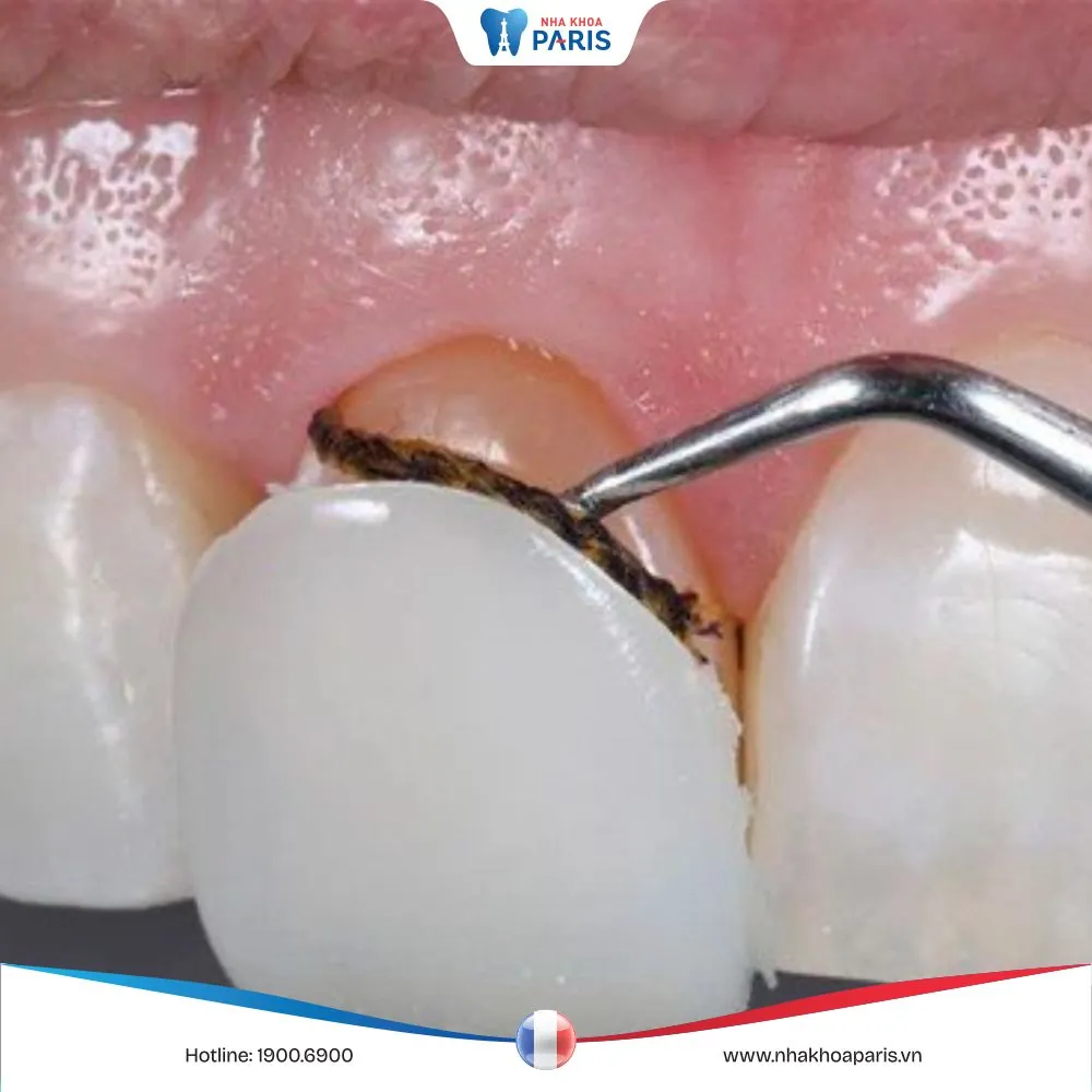 Bác sĩ nha khoa giải đáp: Tháo răng sứ có đau không? 