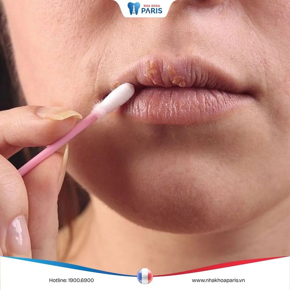 Thuốc bôi Herpes : Cách sử dụng thuốc bôi herpes môi hiệu quả