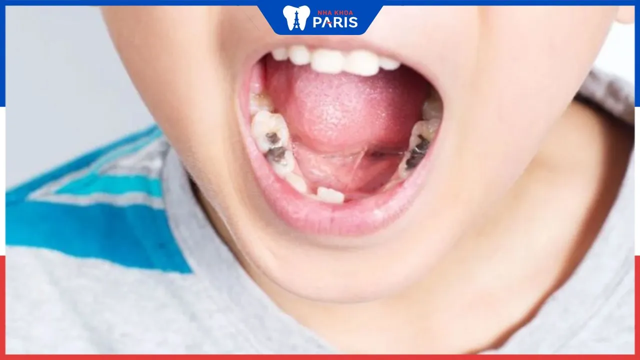 Top 13 thuốc trị sâu răng cho bé an toàn & hiệu quả nhất