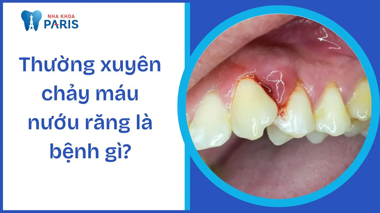 Thường xuyên chảy máu nướu răng là bệnh gì? 11 cách xử lý an toàn