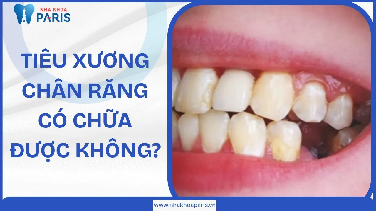Tiêu xương răng: Nguyên nhân, hậu quả và cách chữa trị hiệu quả