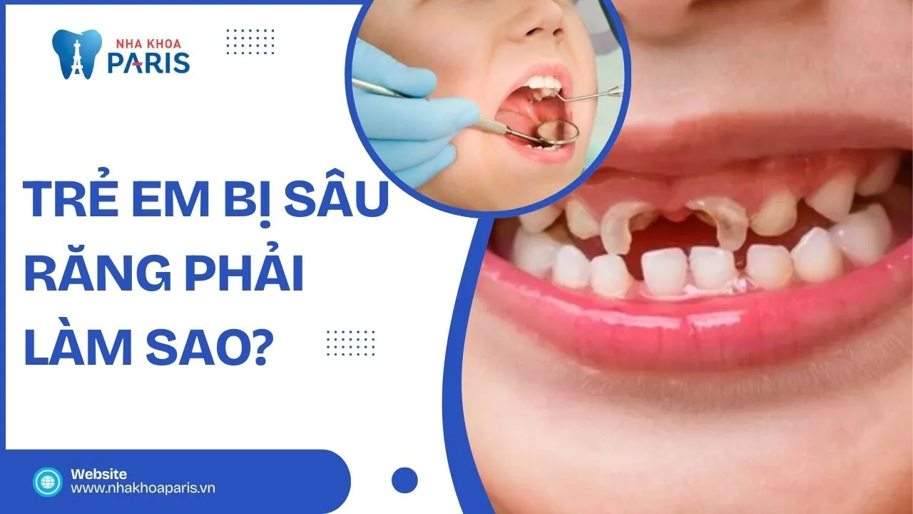 Trẻ em bị sâu răng phải làm sao? Hướng dẫn giải quyết hiệu quả