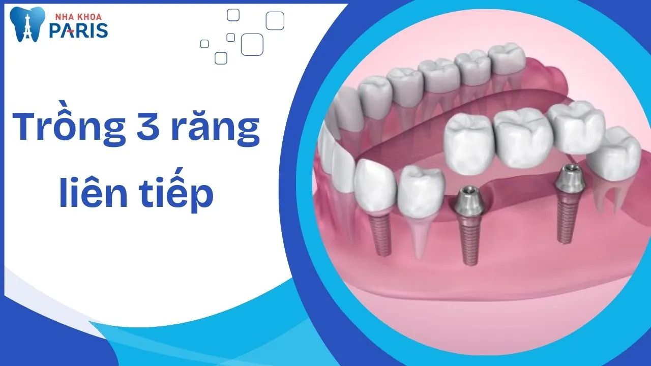 Trồng 3 răng liên tiếp: Phương pháp, chi phí và những yếu tố quan trọng cần biết