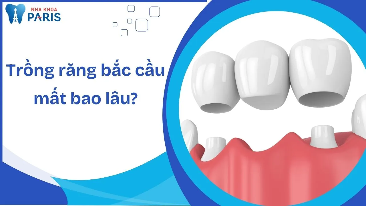 Trồng răng bắc cầu mất bao lâu – 5 ưu điểm nổi bật