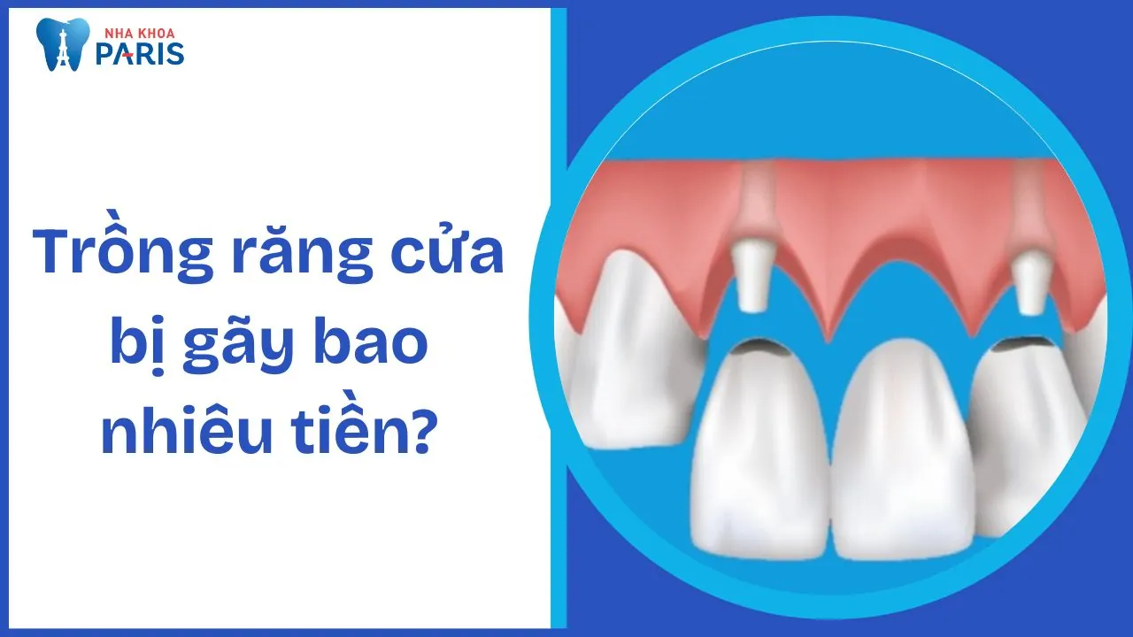 Trồng răng cửa bị gãy: Giải pháp và quy trình điều trị hiệu quả