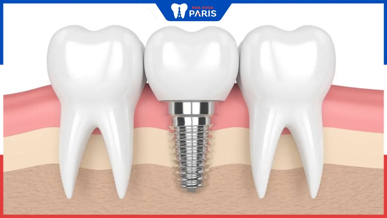 Trồng răng cửa có nguy hiểm không? Lưu ý khi trồng răng cửa