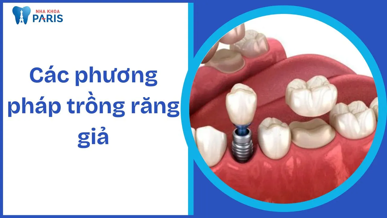 Trồng răng giả – Lợi ích, chi phí và các phương pháp thực hiện
