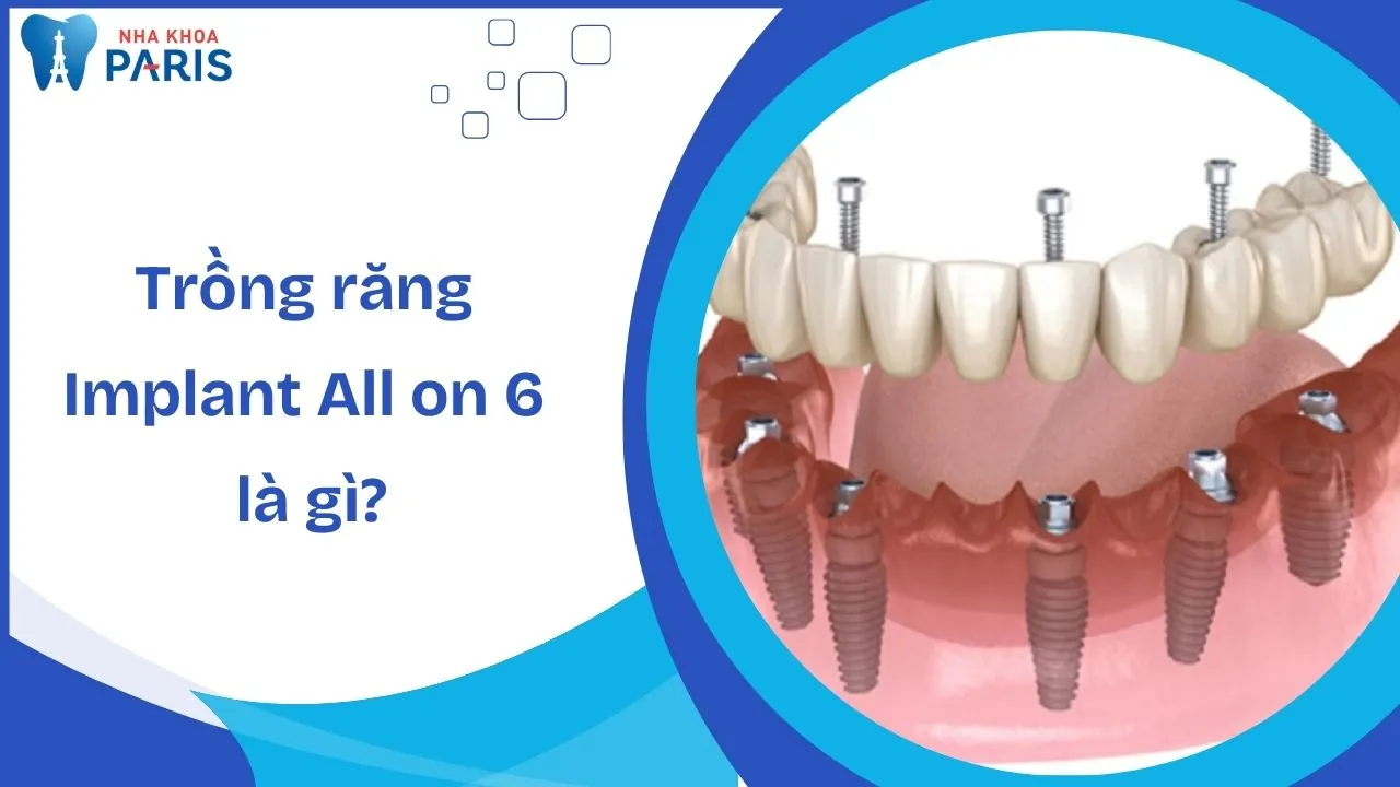 Trồng răng Implant all on 6 là gì? Giải đáp chi tiết từ A – Z