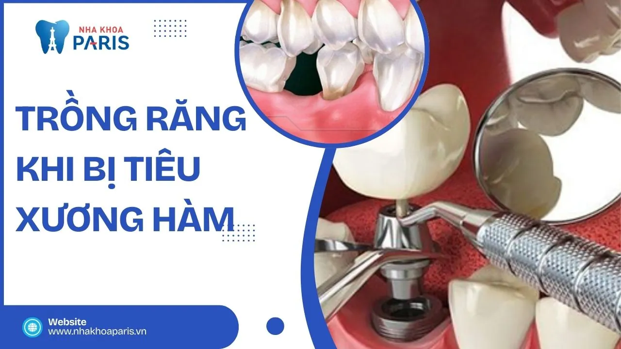 Trồng răng khi bị tiêu xương hàm được không? Cách xử lý an toàn