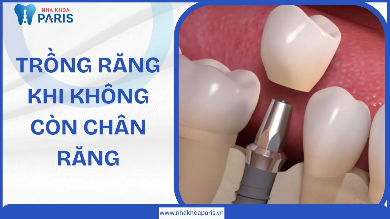 3 phương pháp trồng răng không có chân răng tốt nhất hiện nay