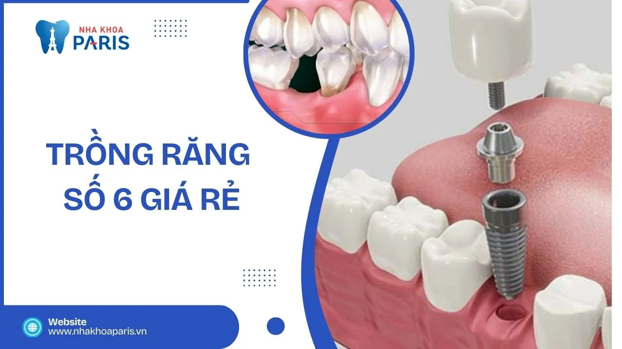 Trồng răng số 6 giá rẻ: 3 phương pháp an toàn và hiệu quả nhất hiện nay