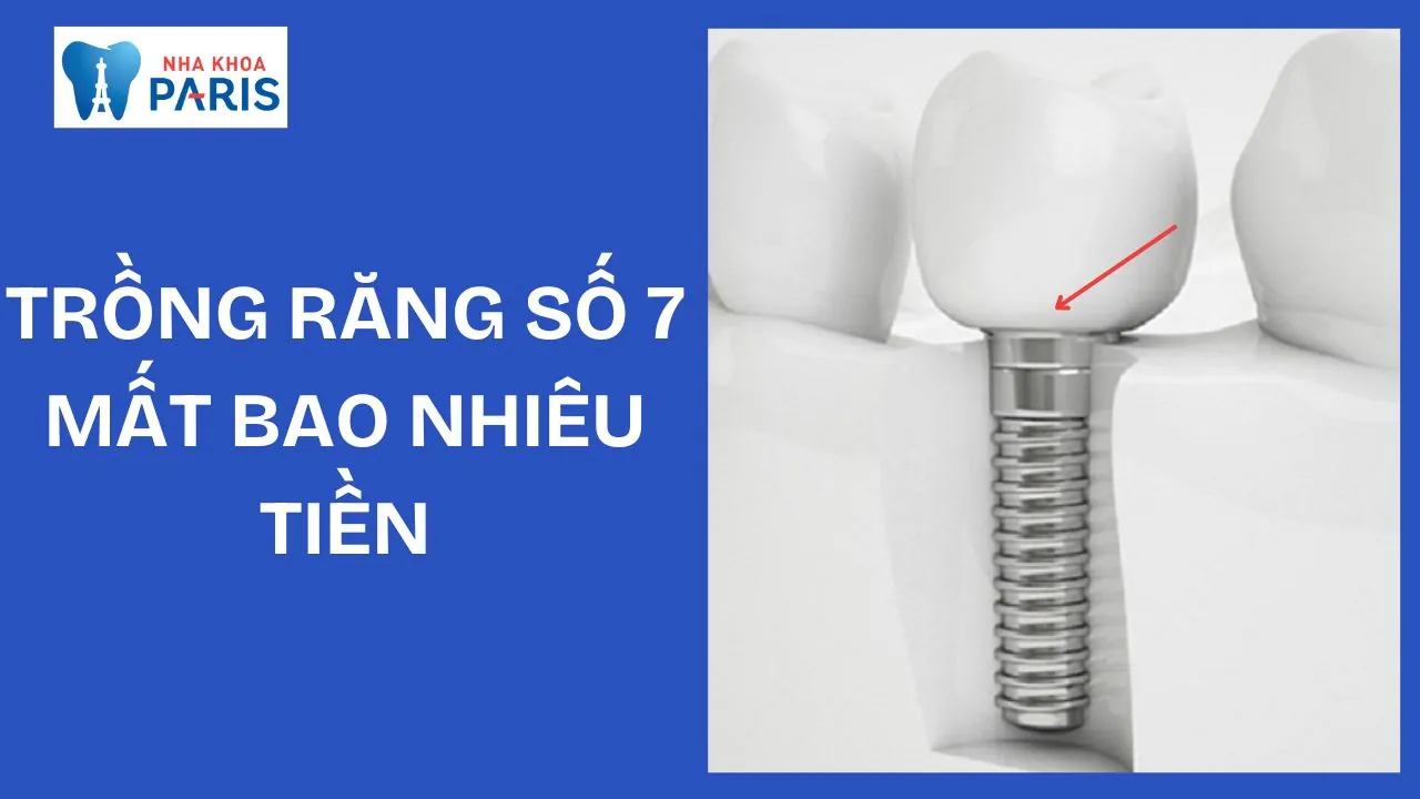Trồng răng số 7 mất bao nhiêu tiền? Phương pháp, quy trình và những điều cần biết