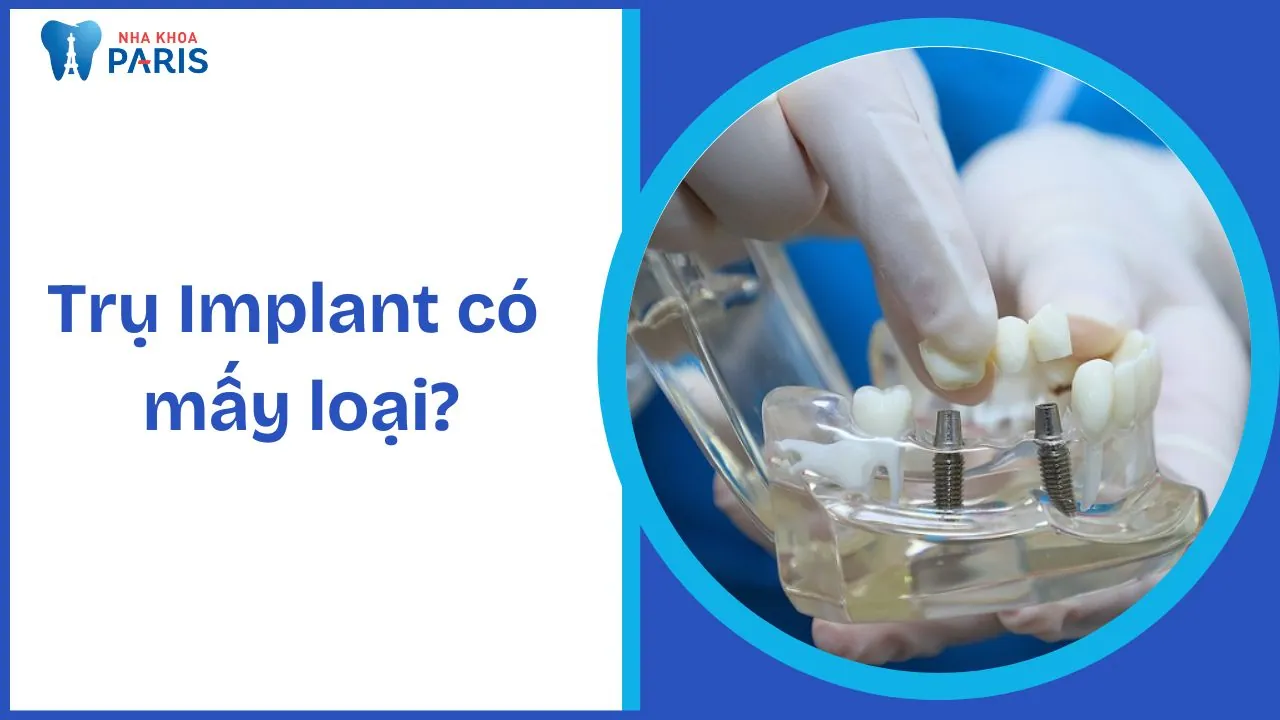 Trụ Implant có mấy loại? Hướng dẫn chi tiết và đánh giá chất lượng