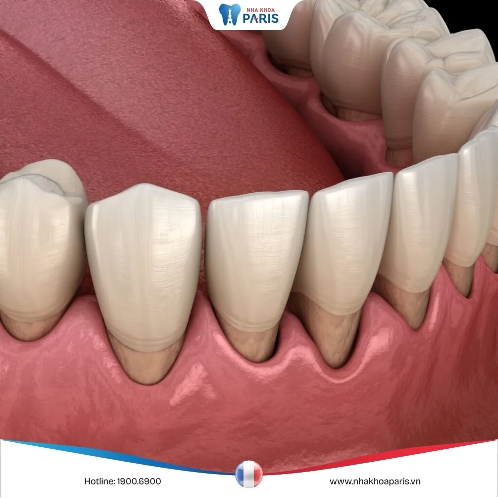 Hiện tượng tụt nướu răng: Nguyên nhân và cách điều trị