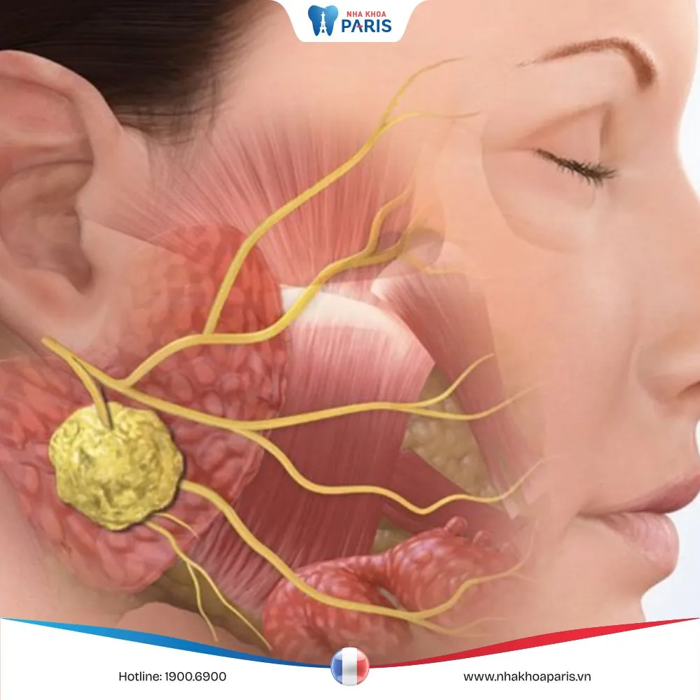 U men xương hàm: Triệu chứng, chẩn đoán và điều trị hiệu quả