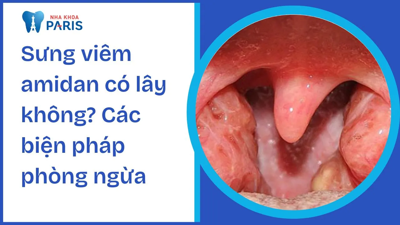 Sưng viêm amidan có lây không? Các biện pháp phòng ngừa