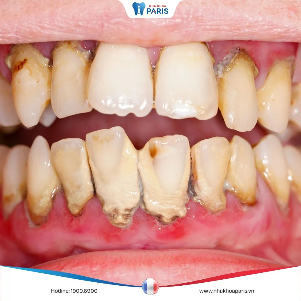 Viêm nha chu: Nguyên nhân và biện pháp điều trị dứt điểm