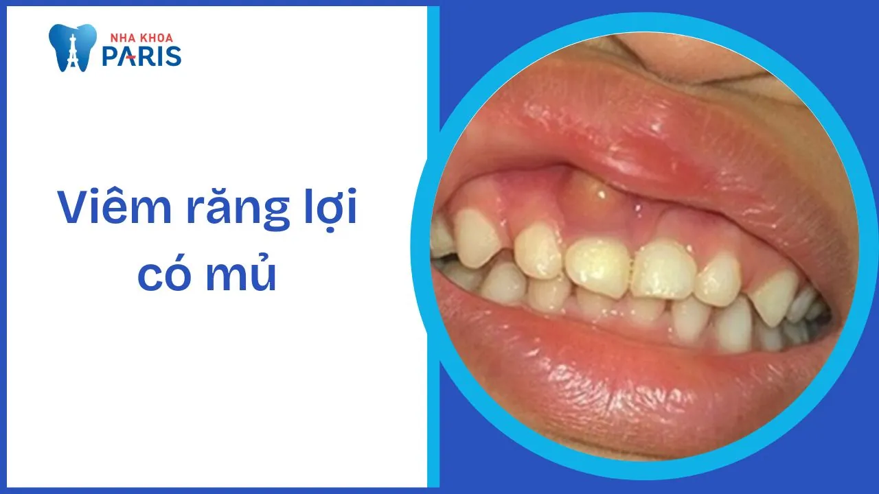 Viêm răng lợi có mủ: Nguyên nhân, triệu chứng và cách điều trị