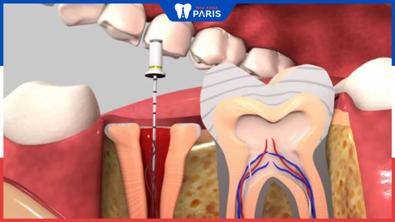 Viêm tủy răng có chữa được không? Các biện pháp điều trị viêm tủy