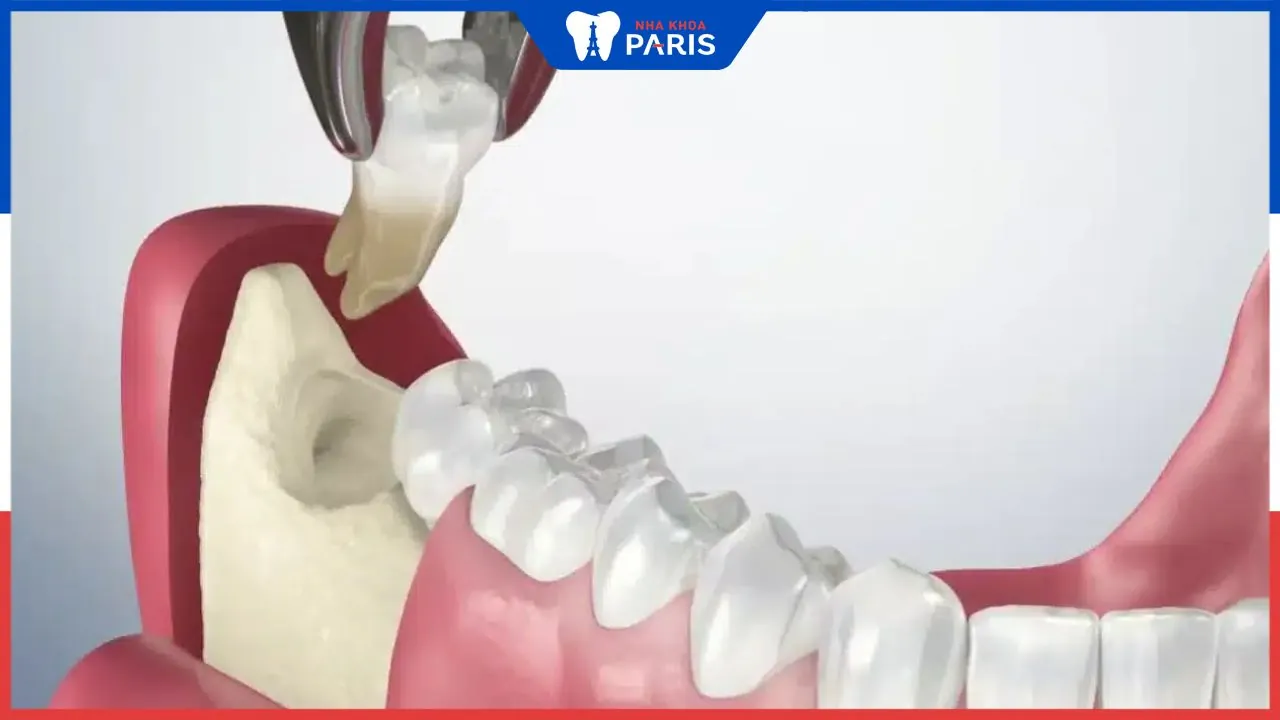 Bảng giá nhổ răng khôn chi tiết, các yếu tố ảnh hưởng