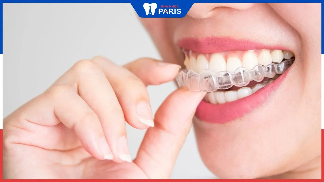 Chi phí niềng răng Invisalign và những yếu tố ảnh hưởng