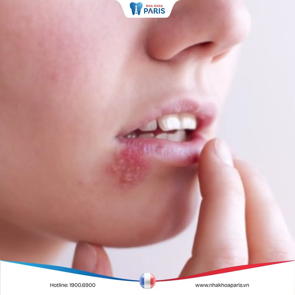 Bị nổi mụn nước ở mép môi: Nguyên nhân và cách điều trị