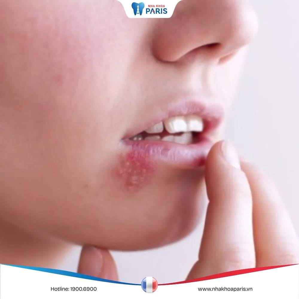 Cách trị mụn nước ở môi nhanh chóng, đơn giản và hiệu quả