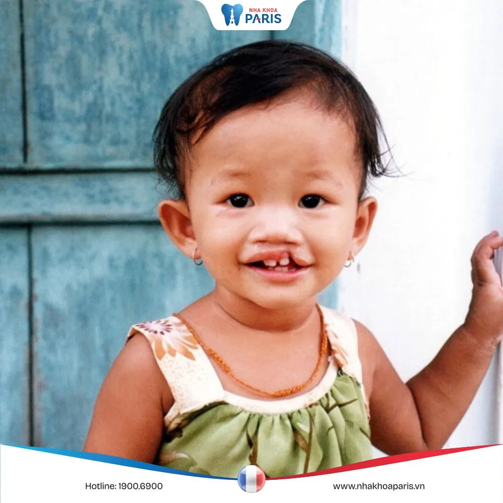 Hở hàm ếch là gì? Cách phát hiện sớm và phương pháp điều trị